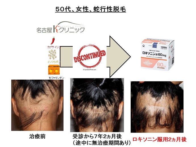 円形脱毛症　病院